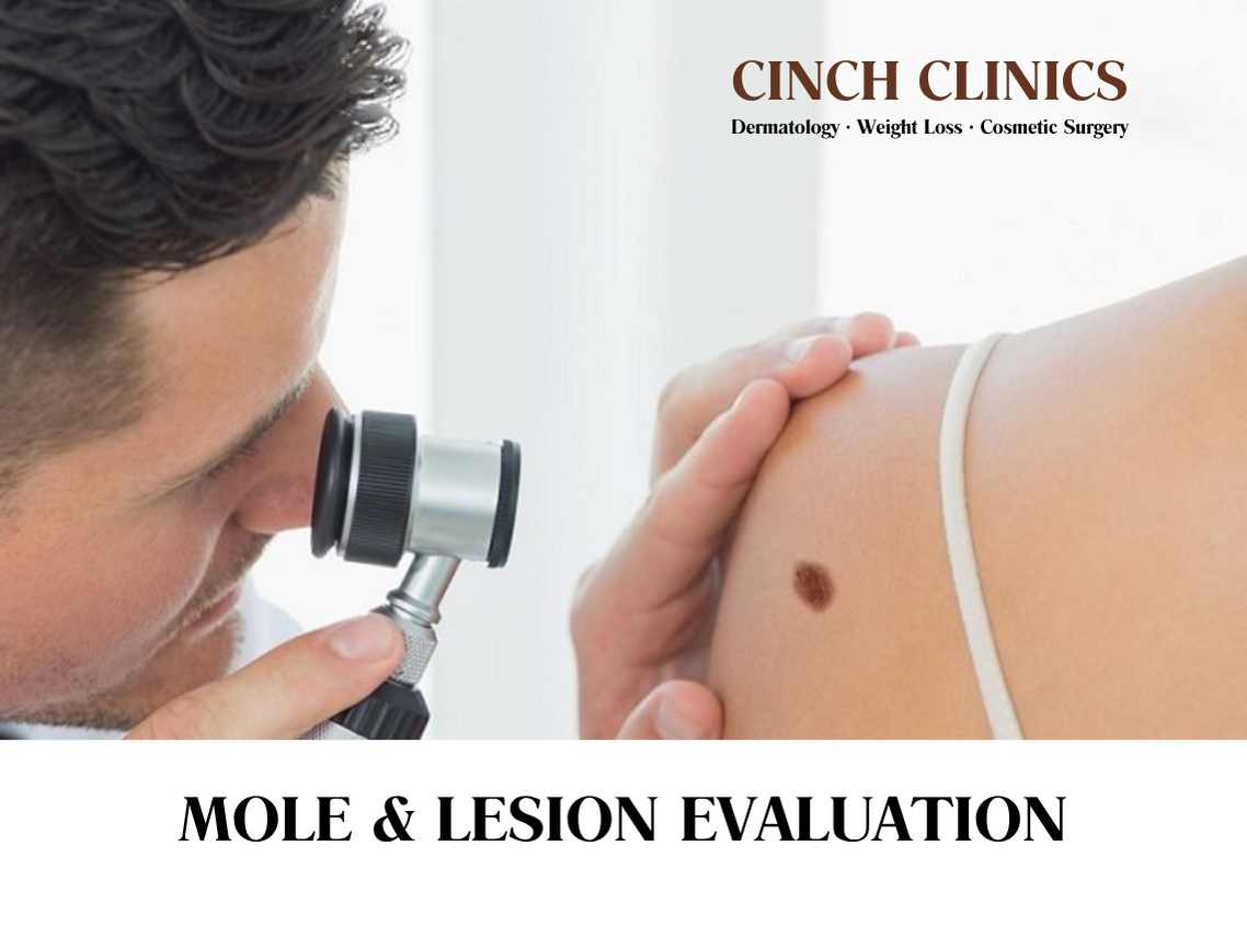 Mole & lesion evaluation at Cinch Clinics