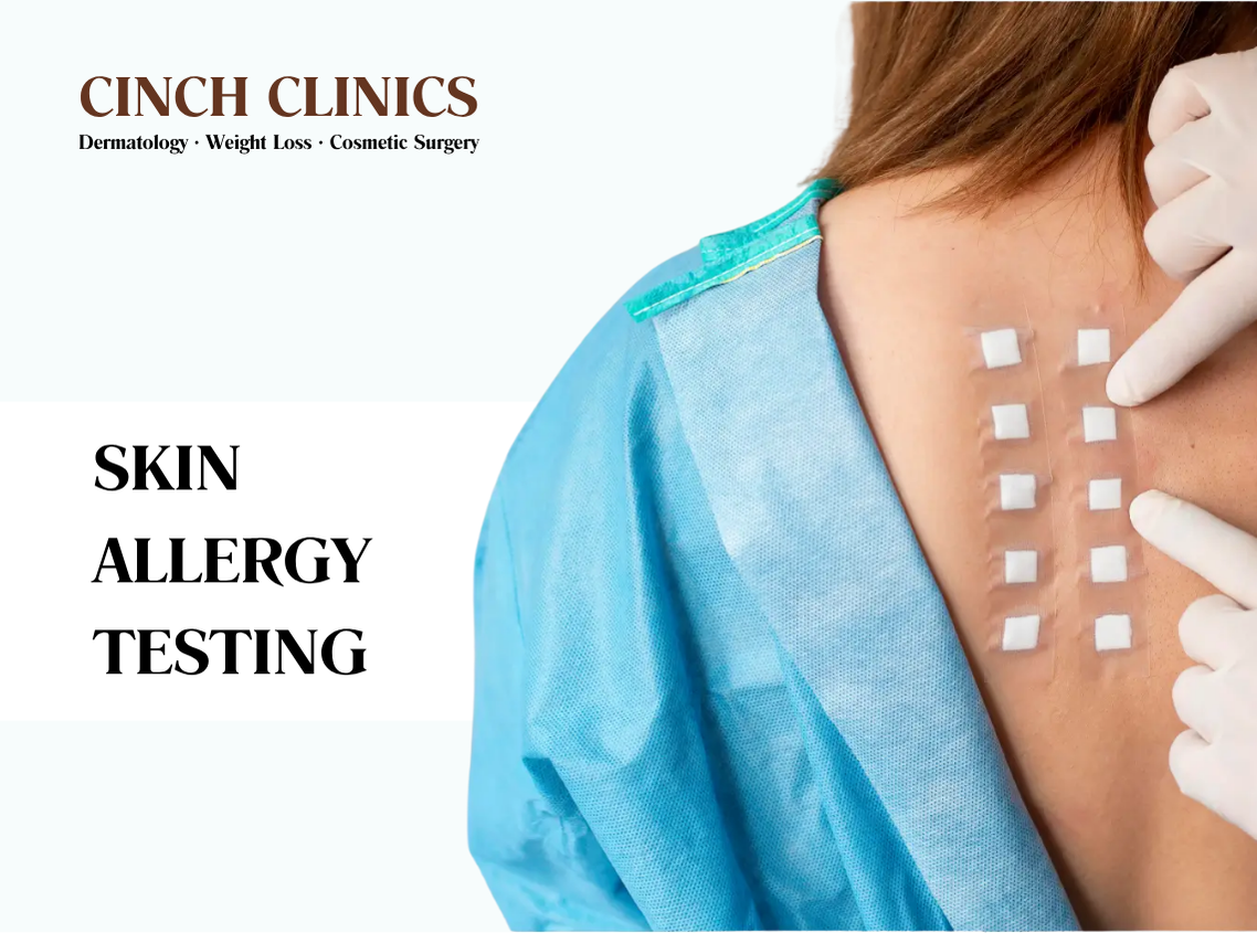 Skin allergy testing at Cinch Clinics
