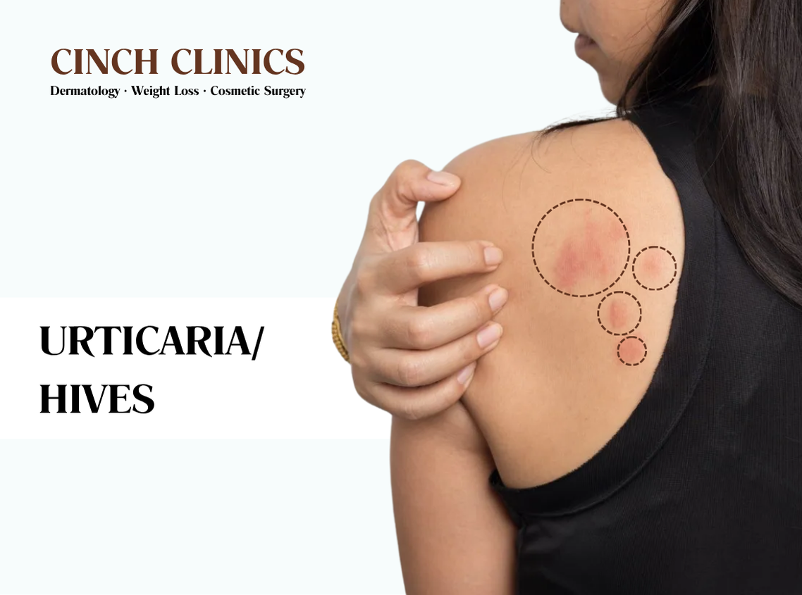 Urticaria at Cinch Clinics