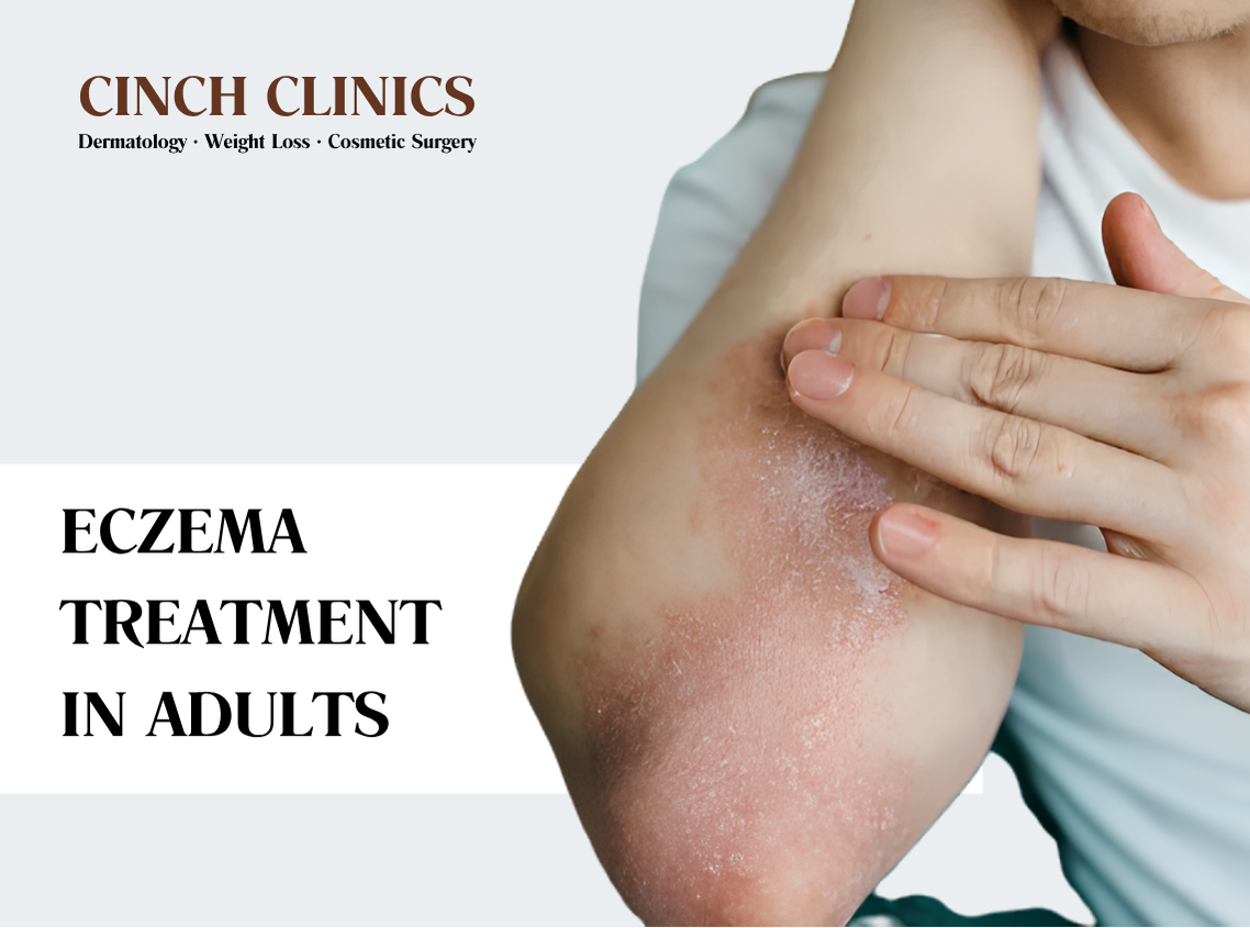 Eczema at Cinch Clinics