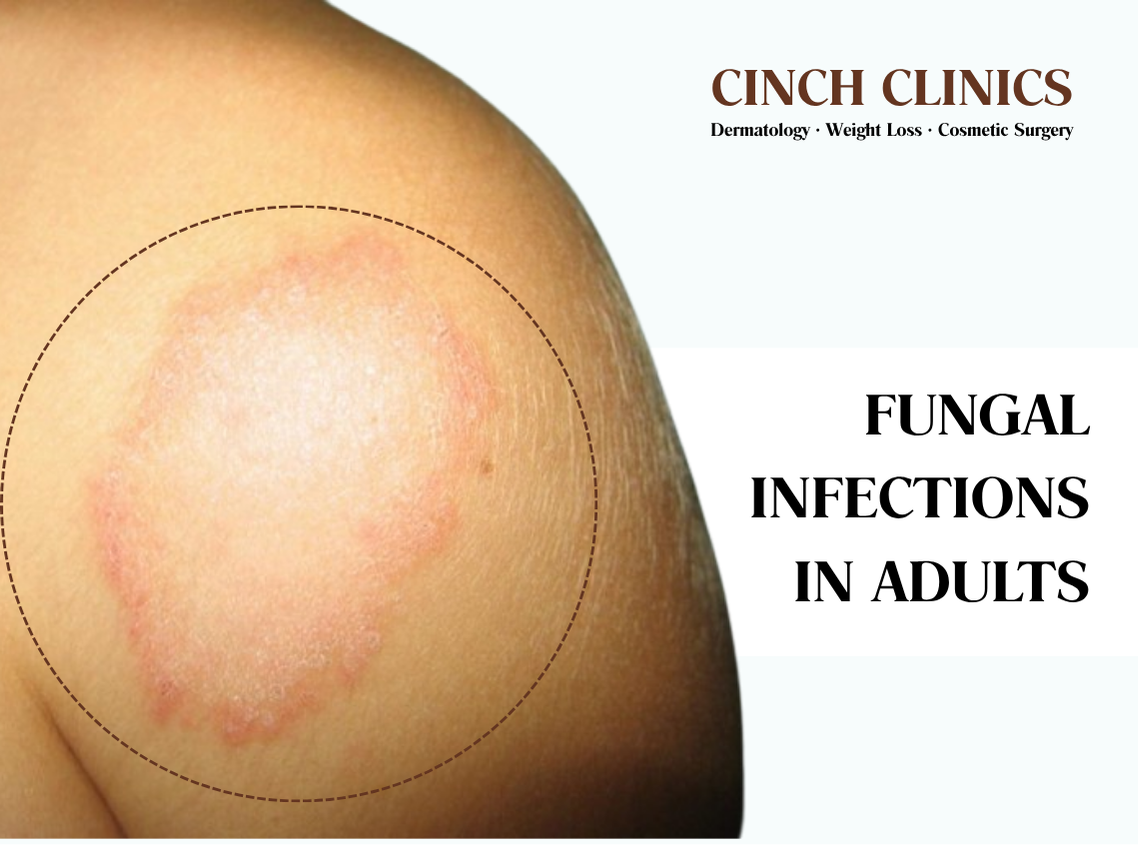 Fungal infections at Cinch Clinics