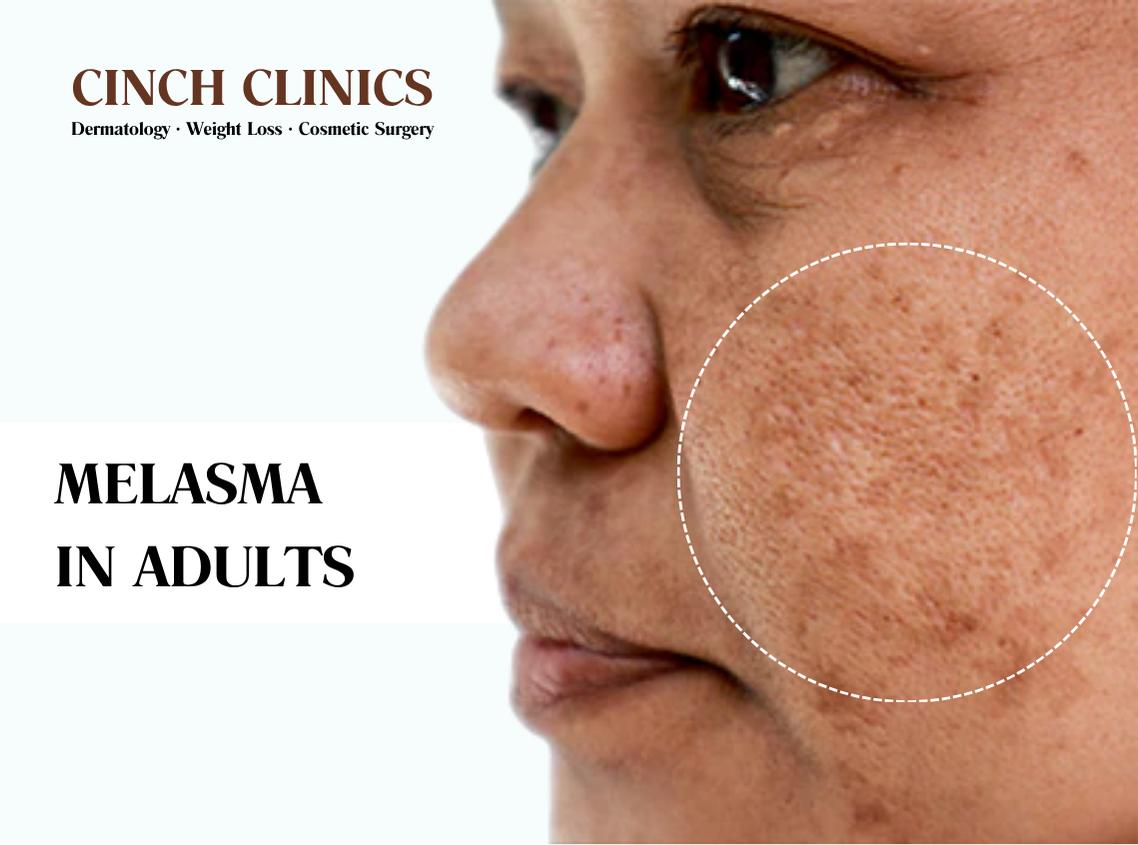 Melasma at Cinch Clinics
