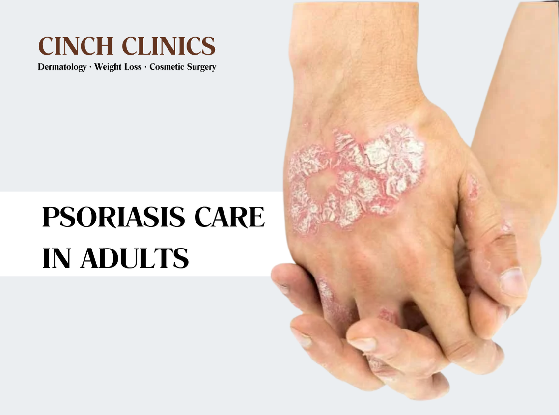 Psoriasis at Cinch Clinics