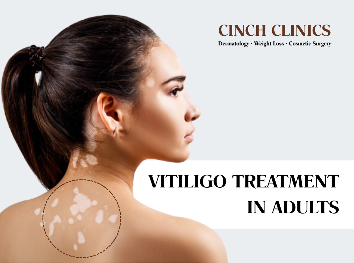 Vitiligo at Cinch Clinics