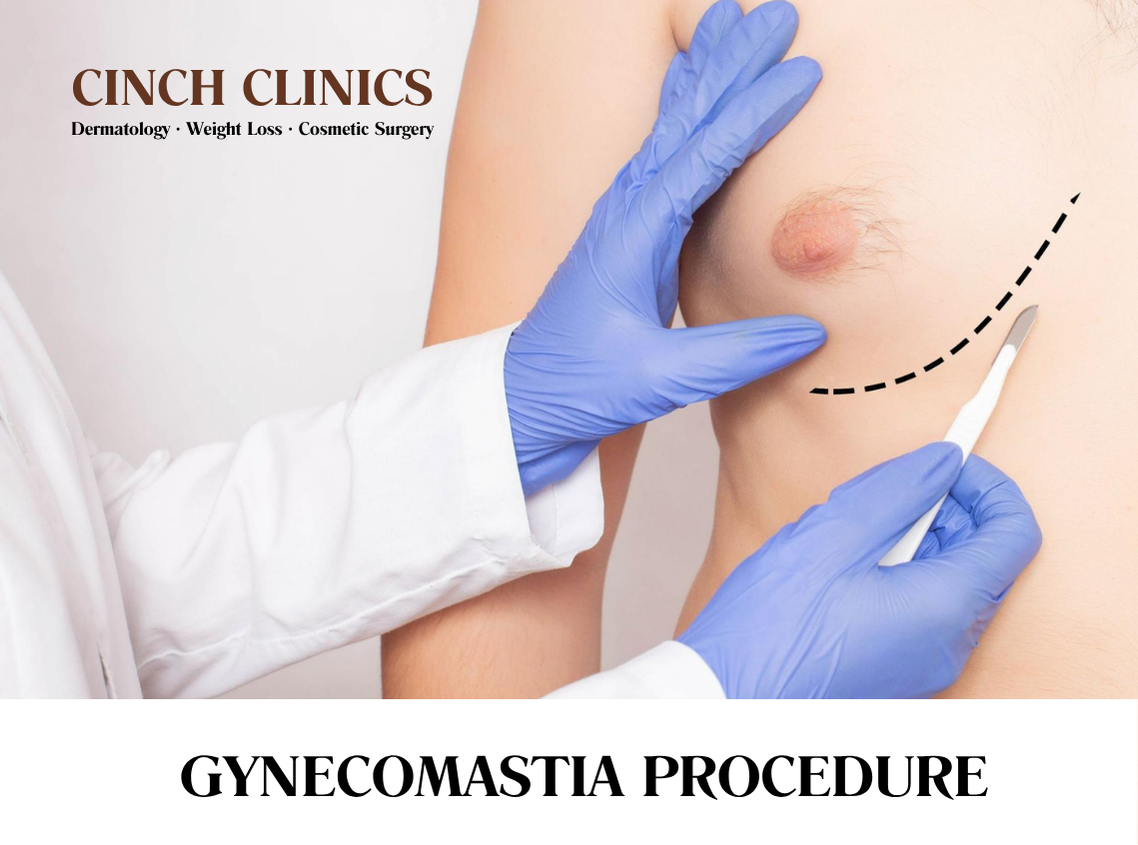 Gynecomastia at Cinch Clinics