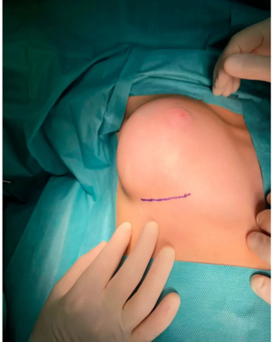Advanced Management of Fibroadenosis at Cinch Clinics