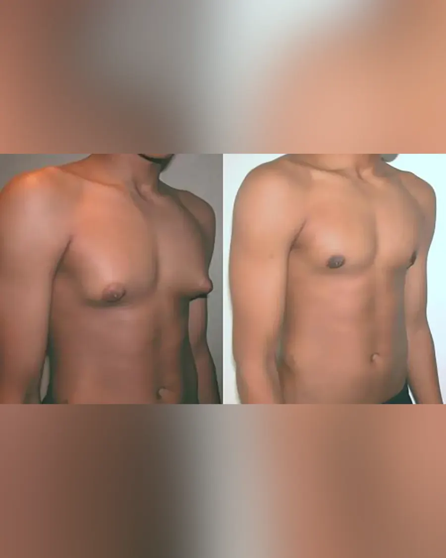 Advanced Chest Contouring with Gynecomastia Treatment at Cinch Clinics
