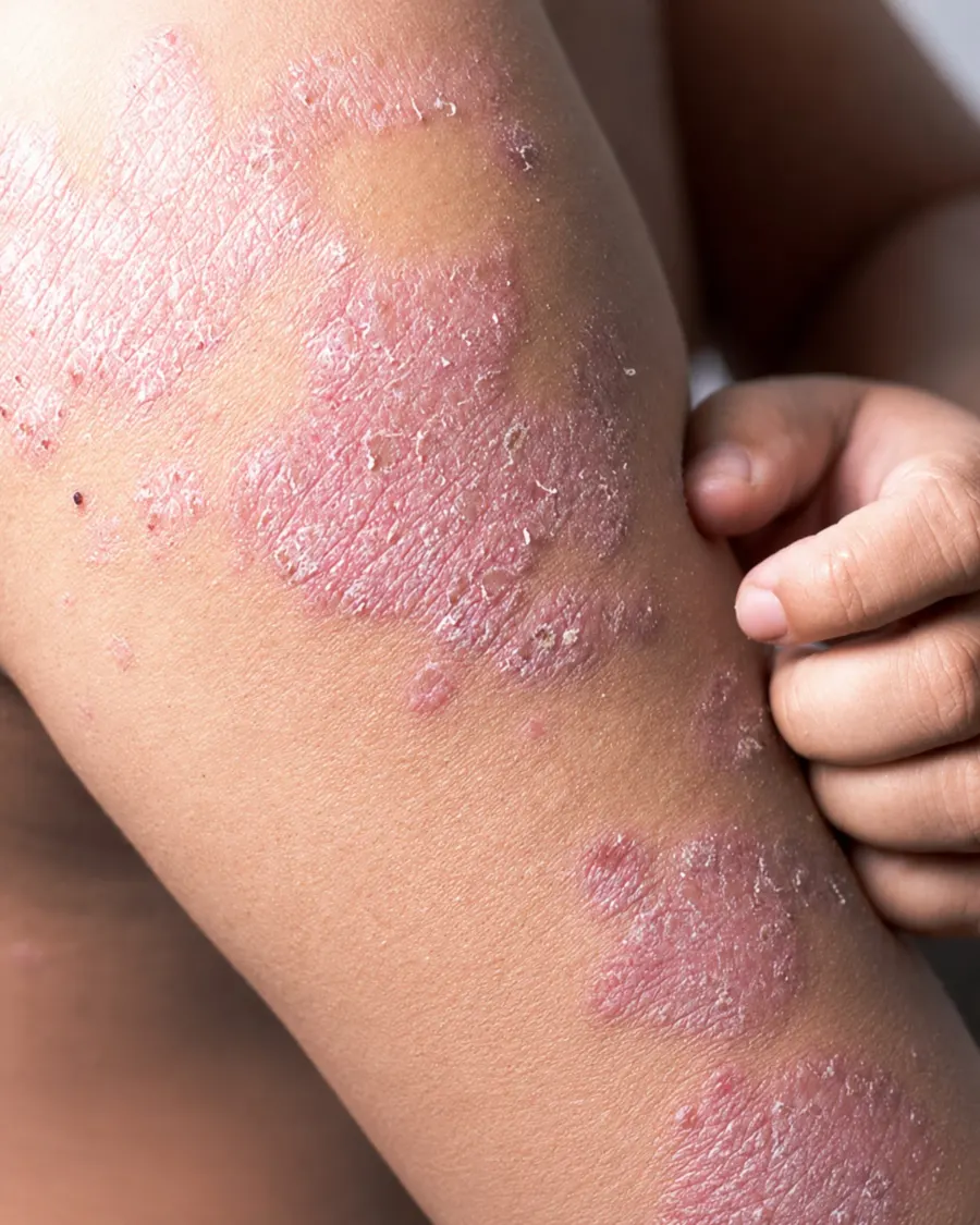 Pediatric dermatology at Cinch Clinics