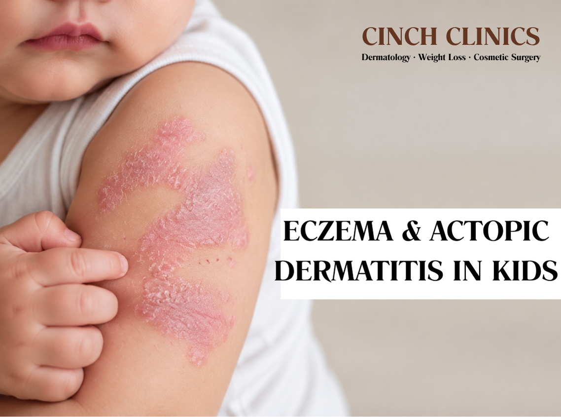 Eczema & atopic dermatitis at Cinch Clinics