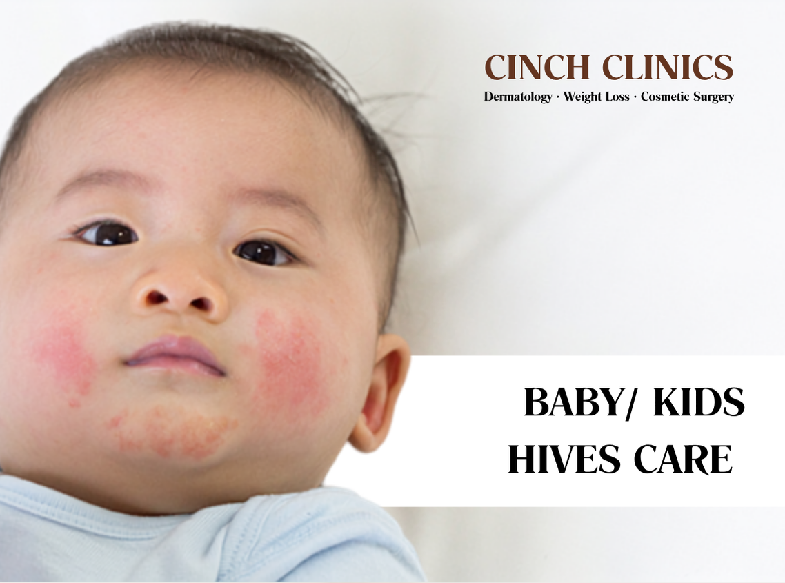 Hives & urticaria at Cinch Clinics