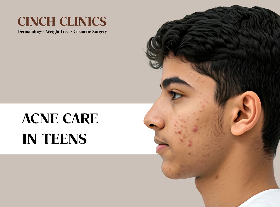 Teen acne at Cinch Clinics