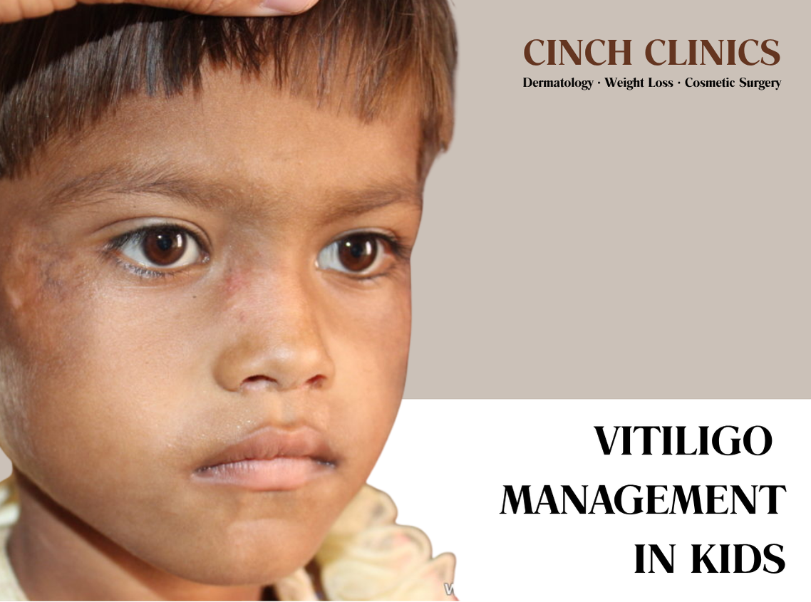 Vitiligo at Cinch Clinics
