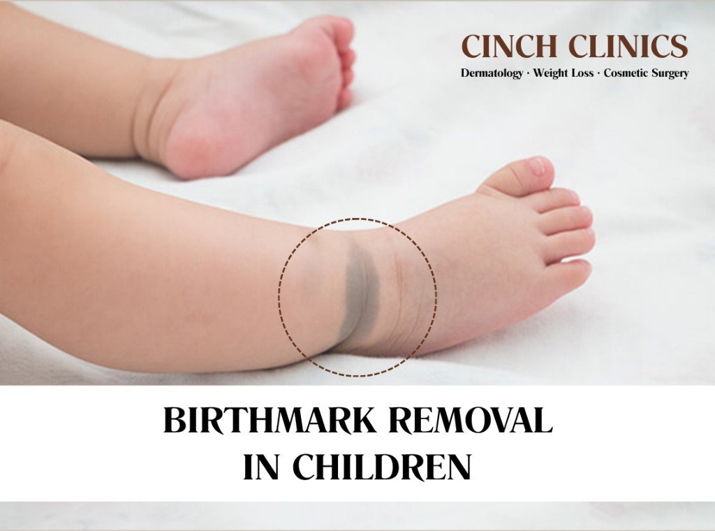 Birthmarks at Cinch Clinics