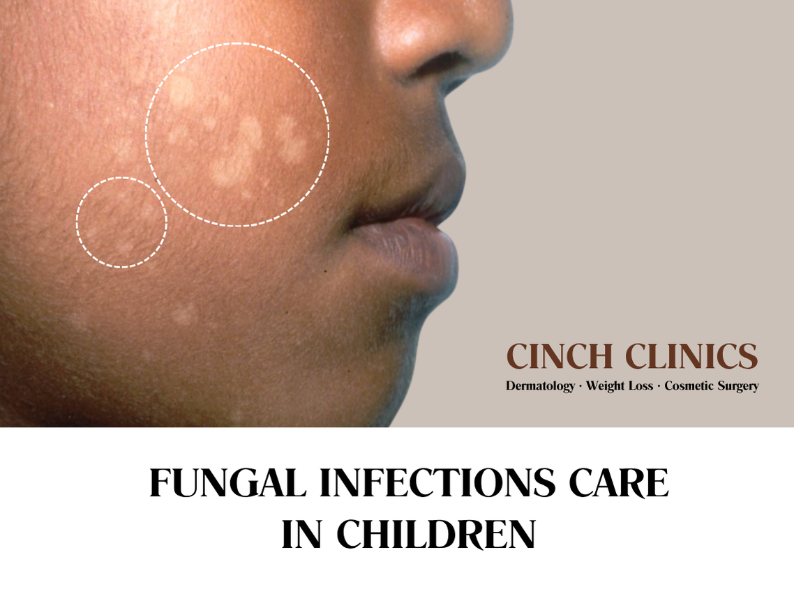 Fungal infections at Cinch Clinics