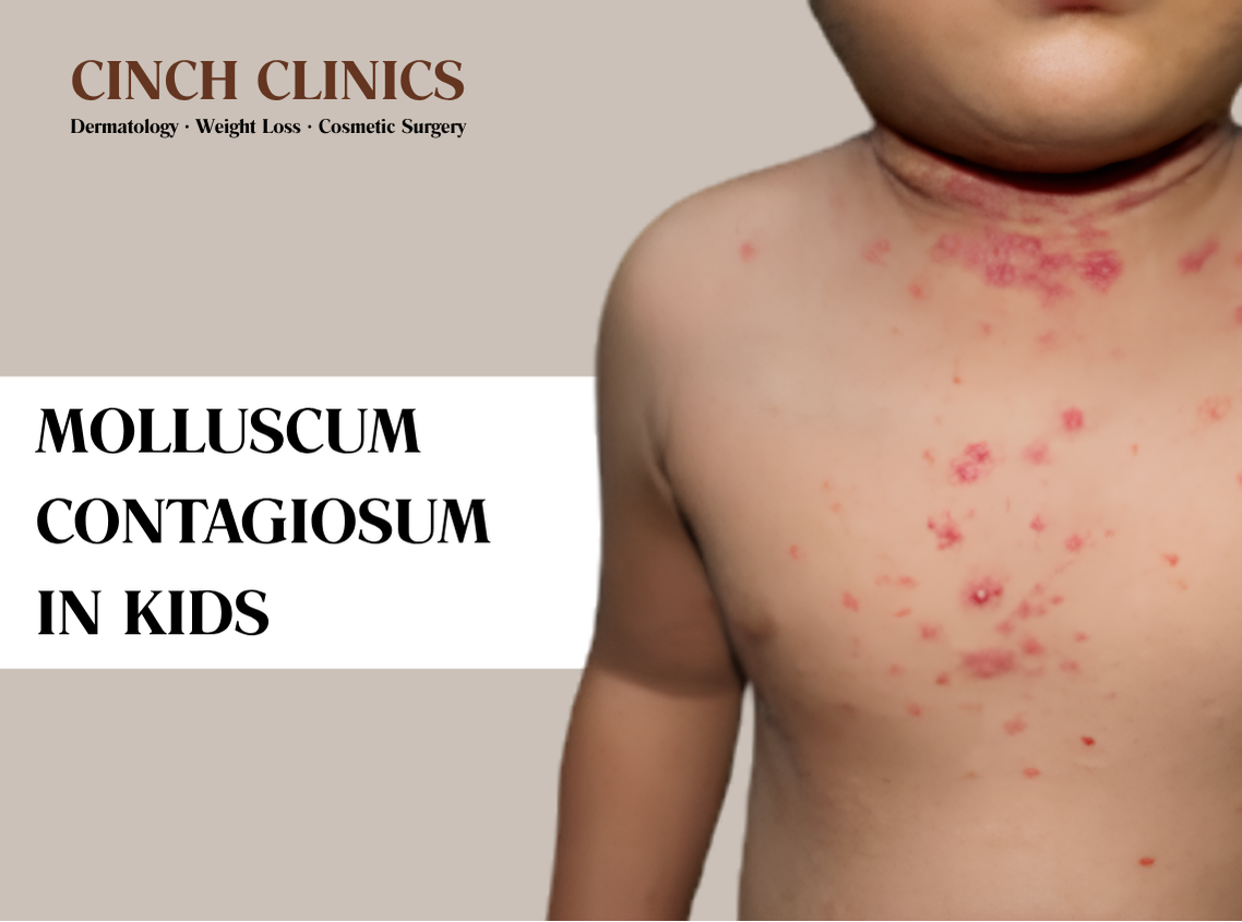 Molluscum contagiosum at Cinch Clinics