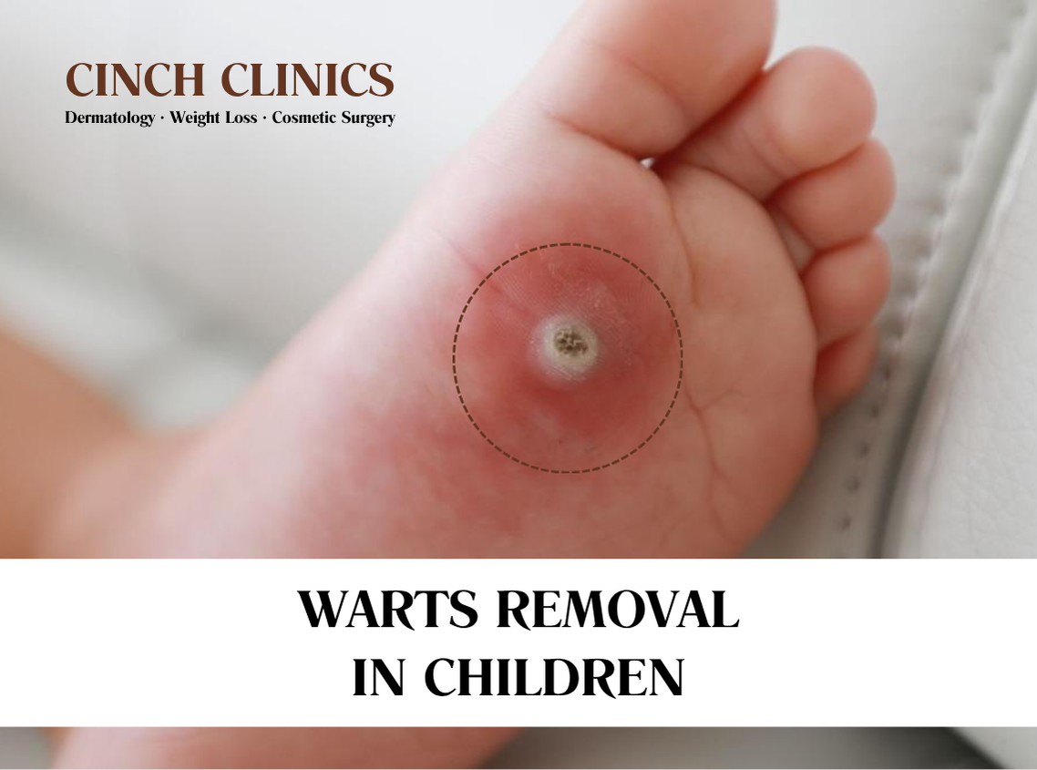 Warts at Cinch Clinics